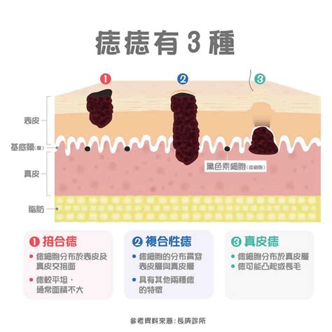 身體很多痣|痣變大、痣多或長毛會變皮膚癌？認識痣的形成與原因